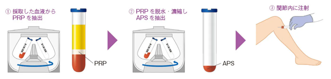 PRP・APSの作成・注入
