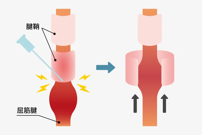 手術療法（腱鞘切開術）